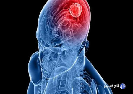 آلودگی هوا با تومورهای مغزی شایع مرتبط است