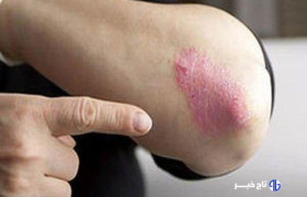 از بیماری «پسوریازیس» چه می دانید