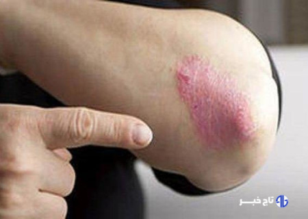 از بیماری «پسوریازیس» چه می دانید