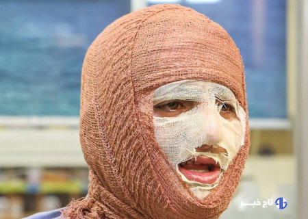 سوختگی؛ آسیب جسمی و روانی که فراتر از درمان است