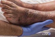 ۱۵ درصد دیابتی‌ها دچار زخم دیابت می‌شوند