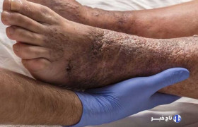 ۱۵ درصد دیابتی‌ها دچار زخم دیابت می‌شوند