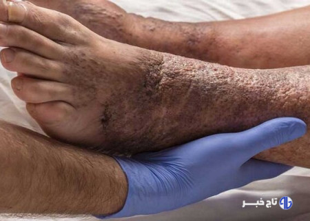 ۱۵ درصد دیابتی‌ها دچار زخم دیابت می‌شوند